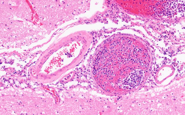 17D4 Lymphoma, intravascular (Case 17) N1 H&E 20X