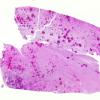 17E1 Lymphoma, intravascular (Case 17) N11 H&E WM