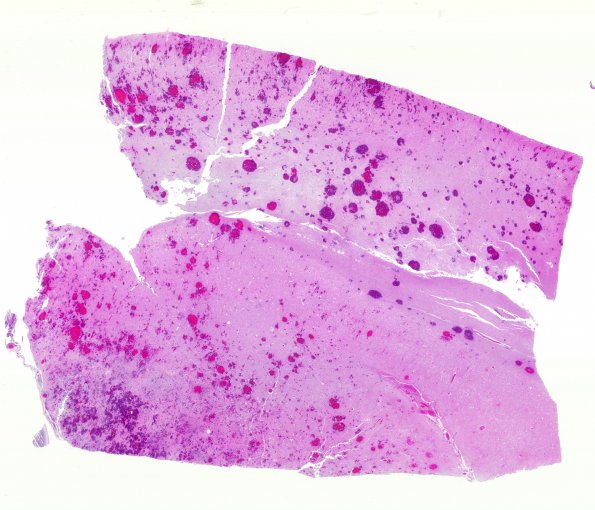 17E1 Lymphoma, intravascular (Case 17) N11 H&E WM