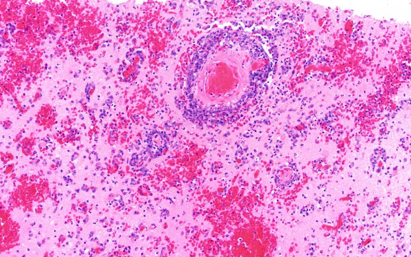 17E3 Lymphoma, intravascular (Case 17) N11 H&E 20X 2