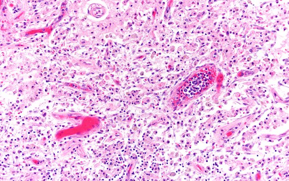 17E5 Lymphoma, intravascular (Case 17) N13 H&E 20X