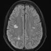 18A1 Lymphoma, intravascular FLAIR - Copy