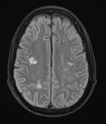 18A1 Lymphoma, intravascular FLAIR - Copy