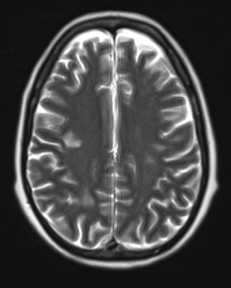 18A2 Lymphoma, intravascular T2 noC - Copy