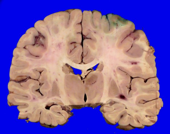 18B1 Lymphoma Gross_6_1