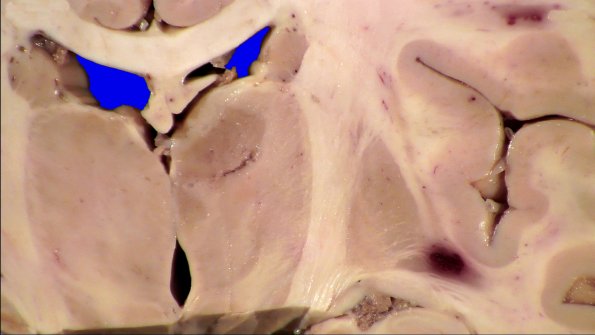 18B2 Lymphoma Gross_6_2