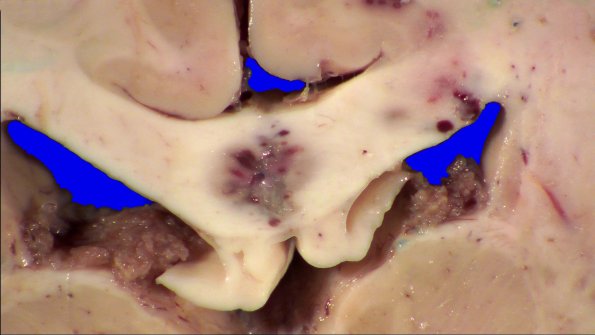 18B4 Lymphoma Gross_1