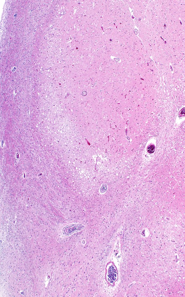 18C2 Lymphoma, intravascular N4 (Case 18) 4X