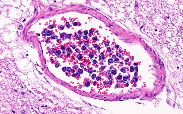 18C3 Lymphoma, intravascular N4 (Case 18) 40X