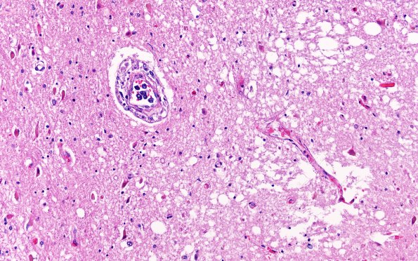 18C4 Lymphoma, intravascular N4 (Case 18) 20X
