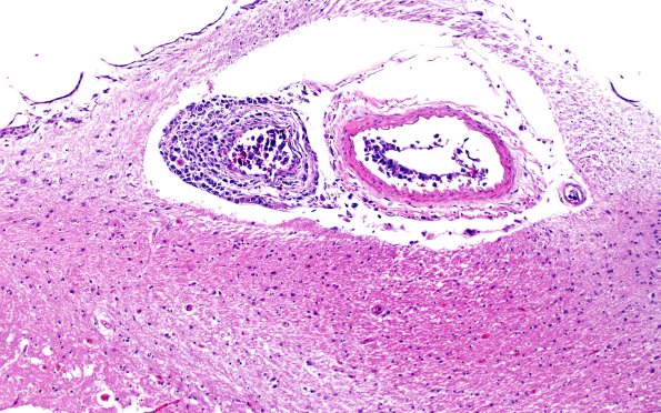 18D1 Lymphoma, intravascular N4 (Case 18) 10X