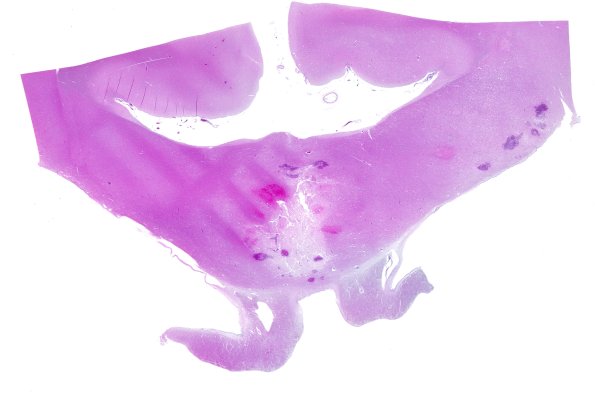 18E1A Lymphoma, intravascular N16 (Case 18)