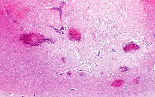 18E1B Lymphoma, intravascular N16 (Case 18)  4X