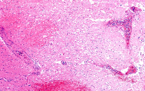 18E1C Lymphoma, intravascular N16 (Case 18)  10X