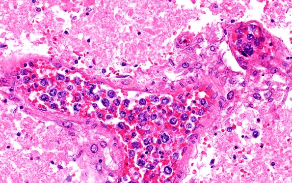 18E1D Lymphoma, intravascular N16 (Case 18)  40X