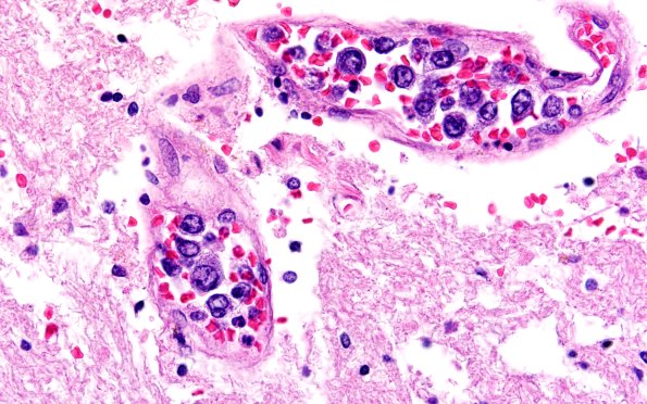 18E1E Lymphoma, intravascular N16 (Case 18)  60X