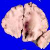 1A2 Intravascular Lymphoma & Venous thrombosis (Case 1)_4