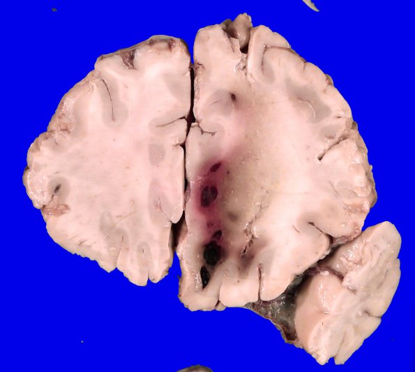 1A2 Intravascular Lymphoma & Venous thrombosis (Case 1)_4