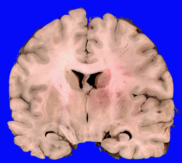 1A3 Lymphoma, intravascular (Case 1) 7