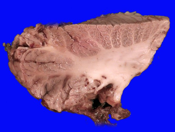 1A4 Lymphoma, intravascular (Case 1) 2