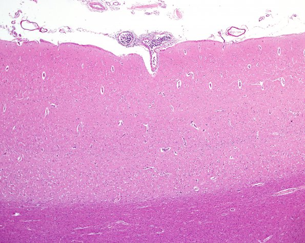 1B1 Lymphoma, intravascular (Case 1) H&E 2