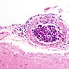 1B2 Intravascular lymphoma (Case 1) H&E 1A