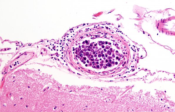 1B2 Intravascular lymphoma (Case 1) H&E 1A