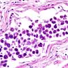 1B3 Lymphoma, intravascular (Case 1) H&E 3