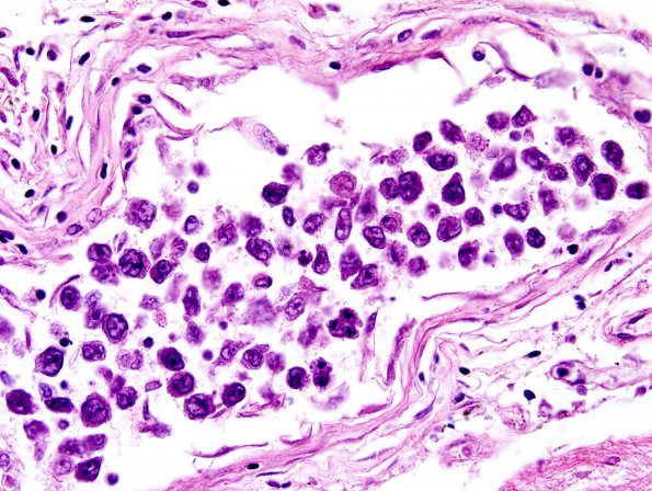 1B3 Lymphoma, intravascular (Case 1) H&E 3