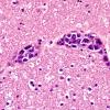 1B5 Lymphoma, intravascular (Case 1) H&E 5