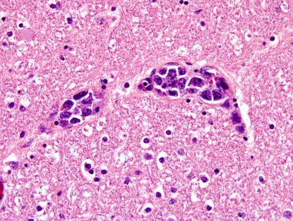 1B5 Lymphoma, intravascular (Case 1) H&E 5