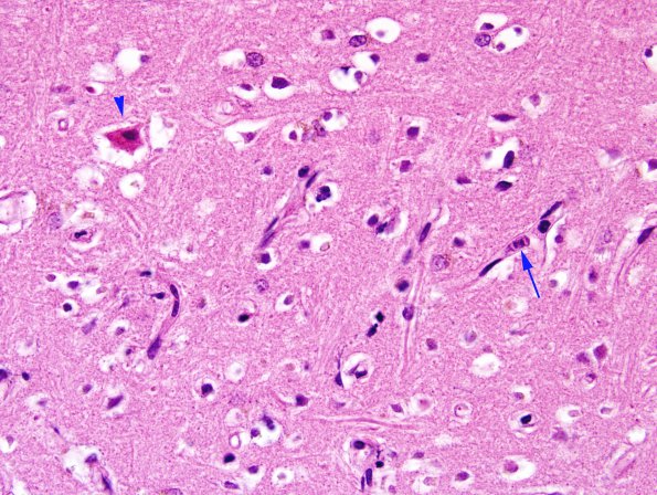 1B6 Lymphoma, intravascular (Case 1) H&E 1 copy.