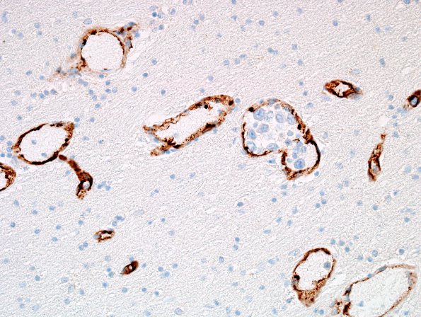 1C1 Lymphoma, intravascular (Case 1) N1 CD34 40X 3