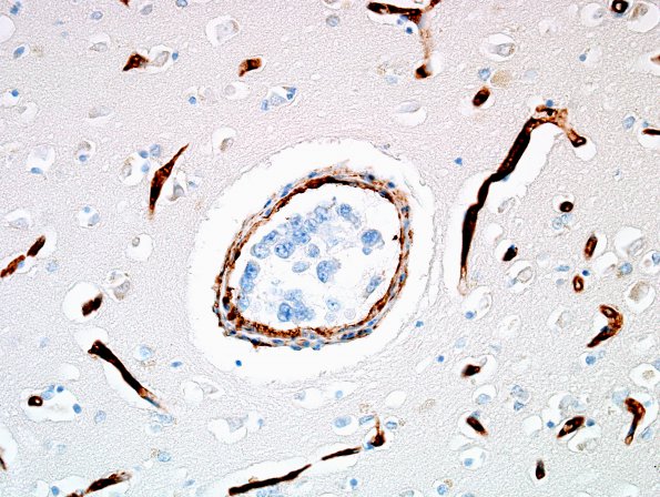 1C2 Lymphoma, intravascular (Case 1) N1 CD34 2