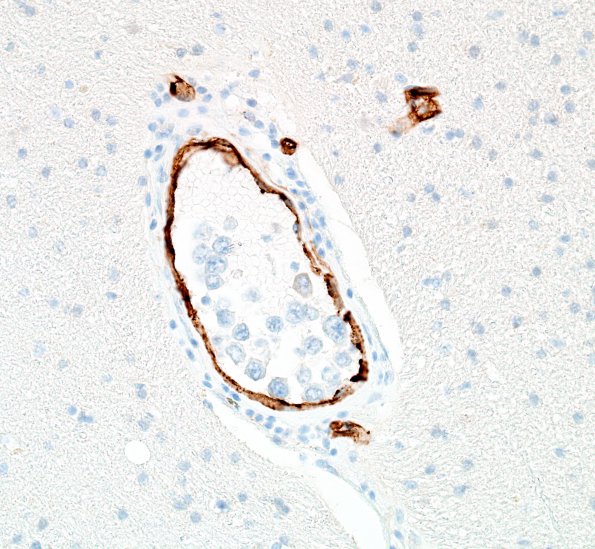 1C3 Lymphoma, intravascular (Case 1) N1 CD34 40X 2