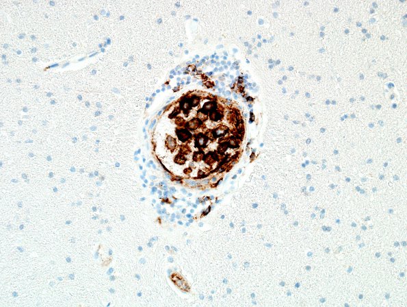 1D1 Lymphoma, intravascular (Case 1) N1 CD20 40X