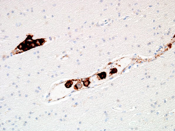 1D2 Lymphoma, intravascular (Case 1) N1 CD20 6