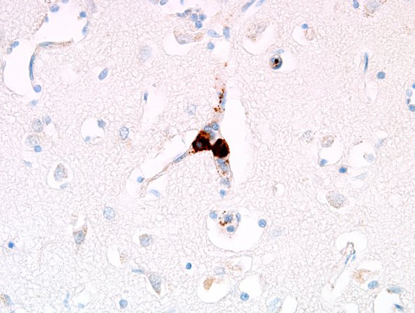 1D3 Lymphoma, intravascular (Case 1) N1 CD20 4