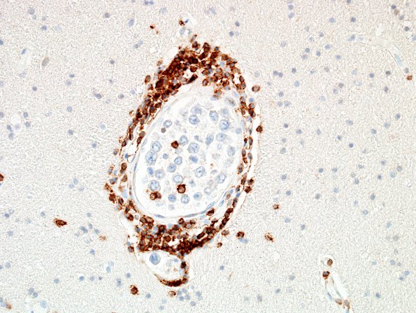 1E Lymphoma, intravascular (Case 1) N1 CD3 40X