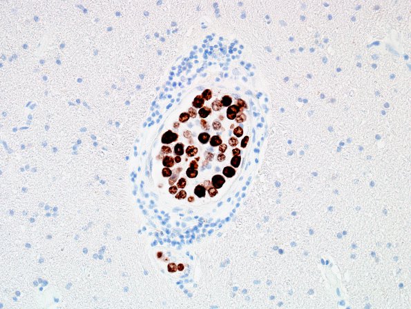 1F1 Lymphoma, intravascular (Case 1) N1 Ki67 40X