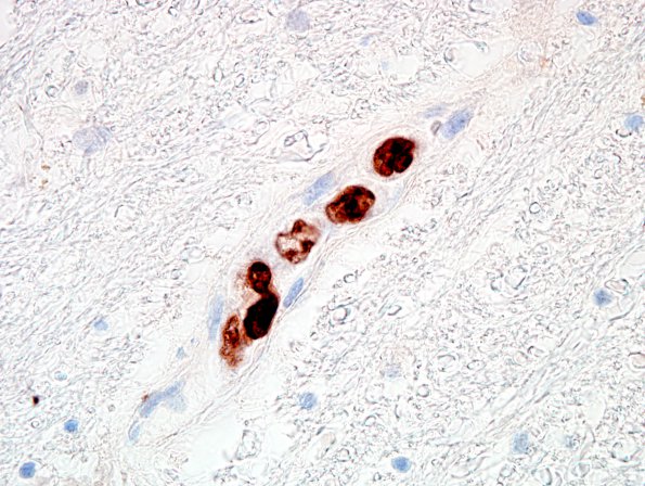 1F2 Intravascular lymphoma (Case 1) Ki67 100X 4