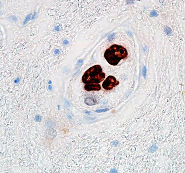 1F3 Intravascular lymphoma (Case 1) Ki67 100X 2