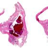 1G1 Lymphoma, intravascular (Case 1) N14 H&E whole mount