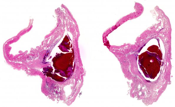 1G1 Lymphoma, intravascular (Case 1) N14 H&E whole mount