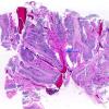 1G2 Lymphoma, intravascular (Case 1) N16 H&E WM copy