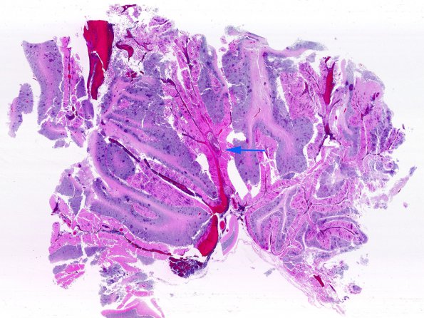 1G2 Lymphoma, intravascular (Case 1) N16 H&E WM copy