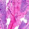 1G3 Lymphoma, intravascular (Case 1) N16 H&E 2X