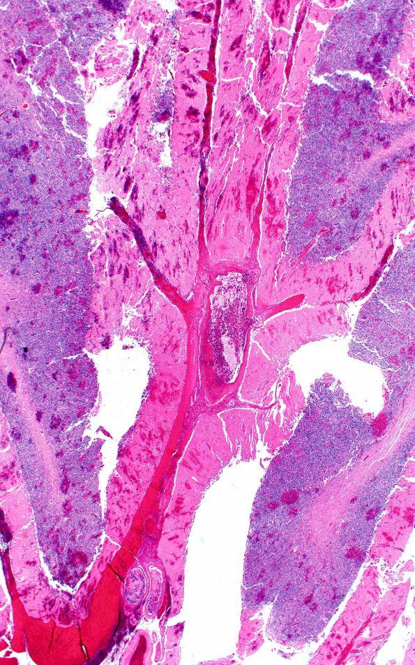 1G3 Lymphoma, intravascular (Case 1) N16 H&E 2X