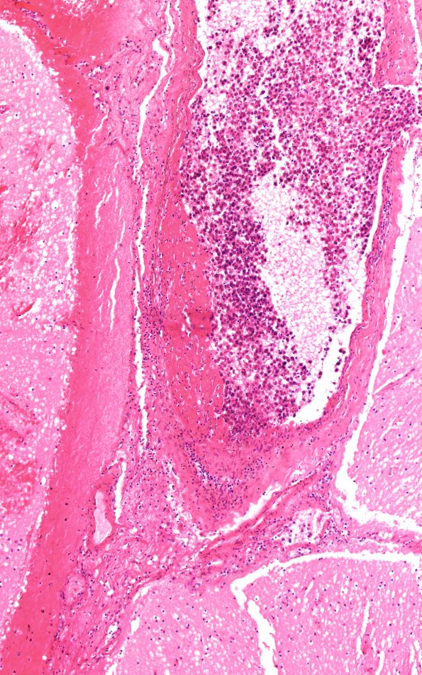 1G4 Lymphoma, intravascular (Case 1) N16 H&E 10X