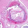 1G5 Lymphoma, intravascular (Case 1) H&E 6.